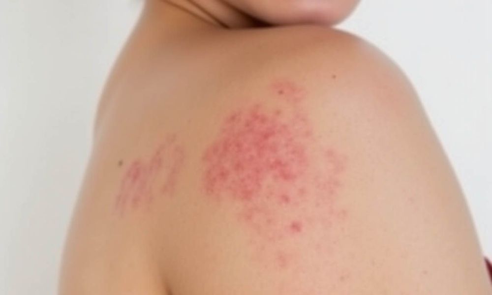 Cả bệnh chàm và da khô đều gây ngứa và khô ráp da.