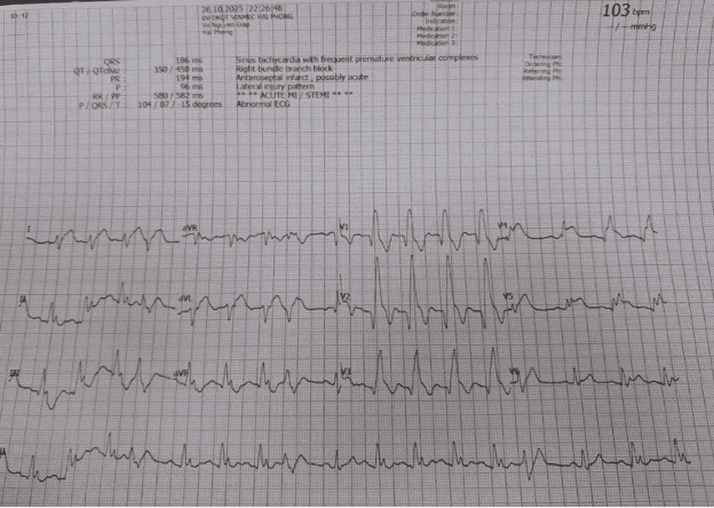 Kết quả điện tâm đồ tại thời điểm nhập viện ghi nhận bệnh nhân bị nhồi máu cơ tim cấp vùng trước rộng và có dấu hiệu rối loạn nhịp tim
