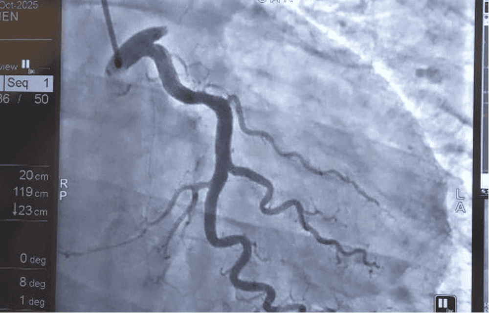 Hình ảnh hình chụp động mạch vành trái (Left Coronary Artery ) cho thấy tắc hoàn toàn ngay từ lỗ vào của động mạch liên thất trước (LAD) - một vị trí rất nguy hiểm