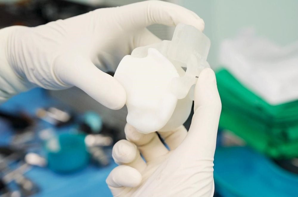 Trước phẫu thuật, mô hình khớp in 3D của bệnh nhân được ê-kíp bác sĩ thiết kế theo dữ liệu giải phẫu của người bệnh