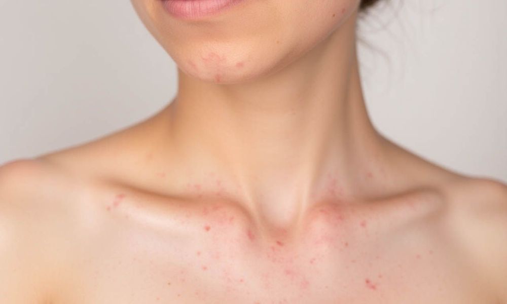 Mụn dị ứng thời tiết có dấu hiệu là mụn nhỏ hoặc mụn trứng cá.