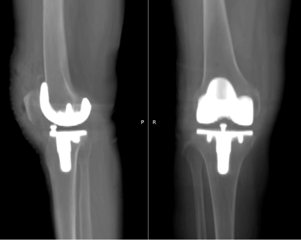 Phim chụp X-quang của bệnh nhân sau ca mổ thay khớp nhân tạo
