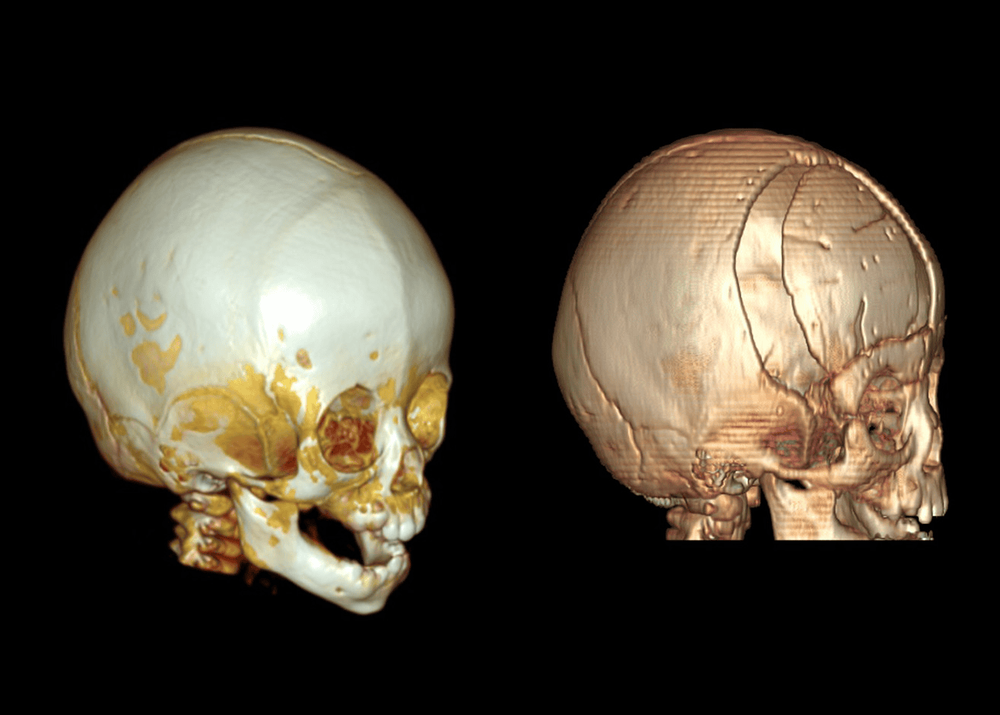Phim chụp cắt lớp dựng hình 3D trước phẫu thuật (bên trái) và sau phẫu thuật (bên phải) của bé M.T