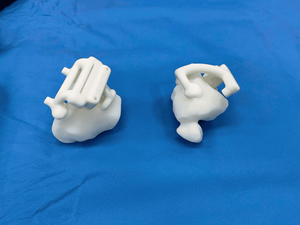 Mô hình in 3D được thiết kế riêng cho người bệnh