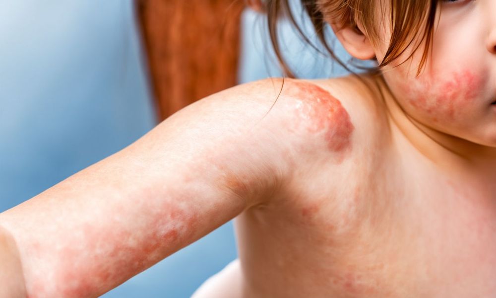 Dị ứng do côn trùng đốt có thể gây ra các vết mẩn đỏ, sưng hoặc ngứa.