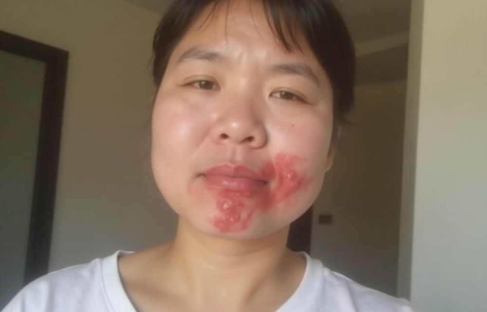 Chàm là một bệnh lý viêm da mạn tính có cơ chế sinh bệnh phức tạp.