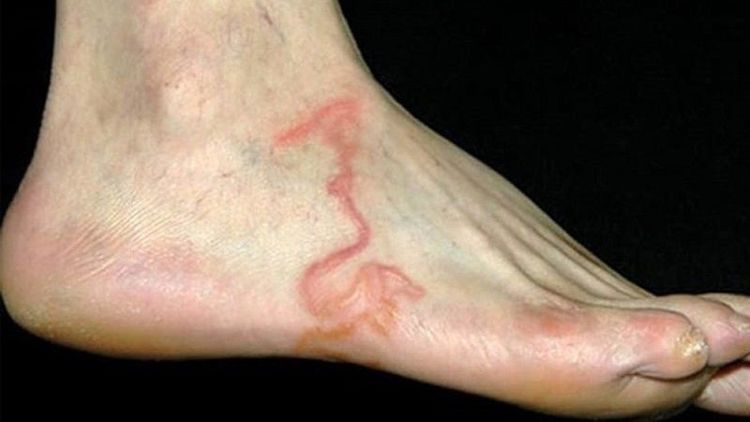 The human body is the primary host for threadworms