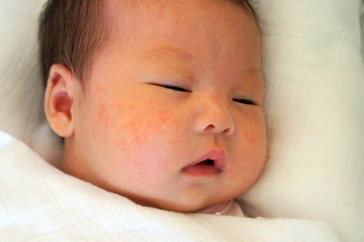 A maculopapular rash, slightly raised but smooth, is one of the manifestations of measles.  
