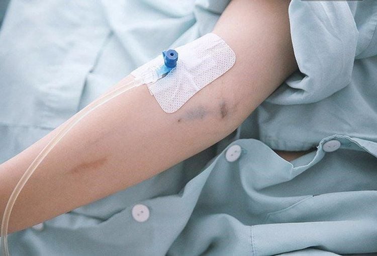 Intravenous infusion technique with catheter lock
