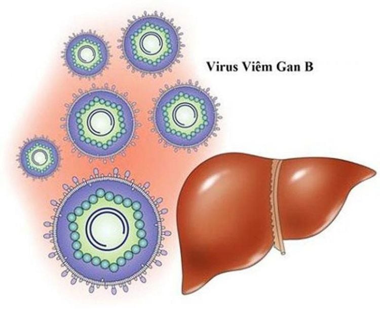 Viêm gan B là bệnh do virus viêm gan B gây ra.