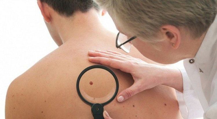 Những thay đổi bất thương trên da có thể là dấu hiệu của ung thư da