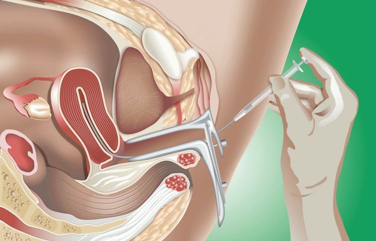 Sperm washing before IUI