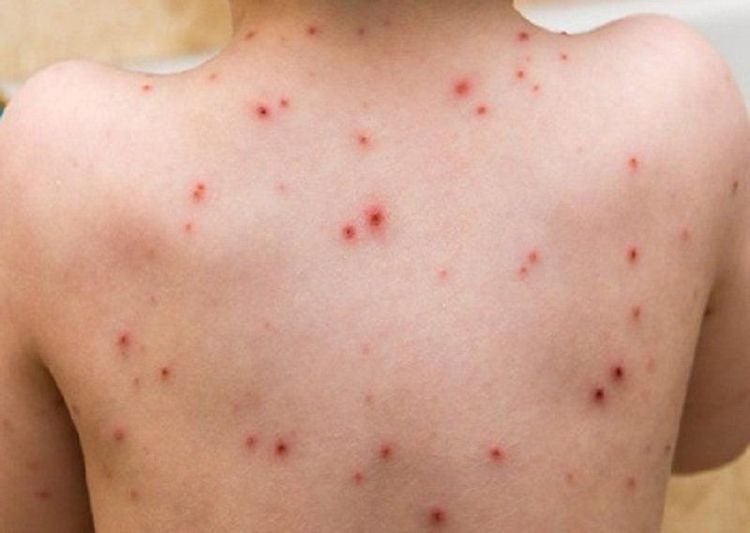 Vảy phấn dạng lichen nổi dưới dạng mụn nước, có dạng đậu mùa