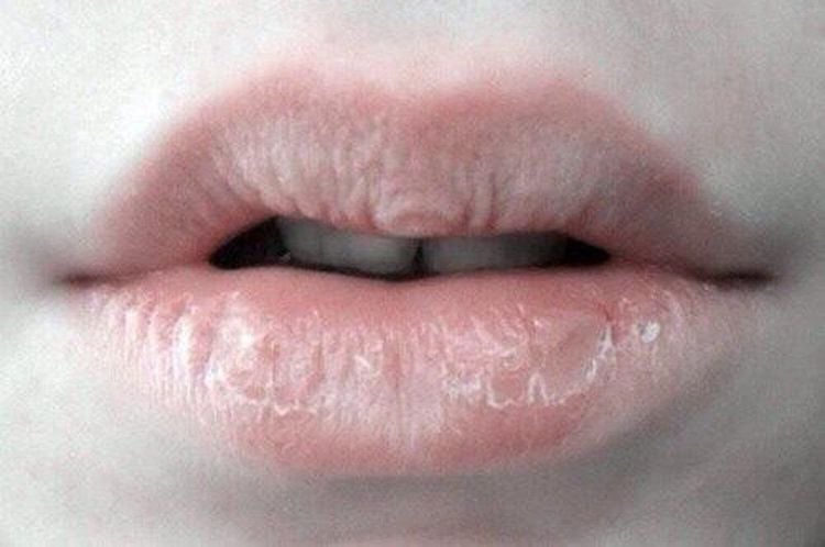 
Bệnh nhân xuất hiện các triệu chứng môi khô,lưới bẩn có thể là dấu hiệu của hội chứng nhiễm khuẩn
