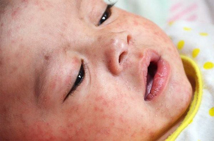 Patient with measles
