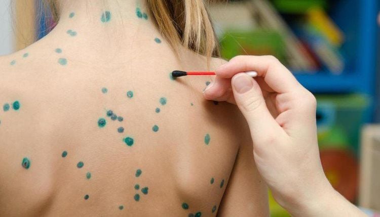 Methylene Blue helps disinfect and heal chickenpox blisters quickly.