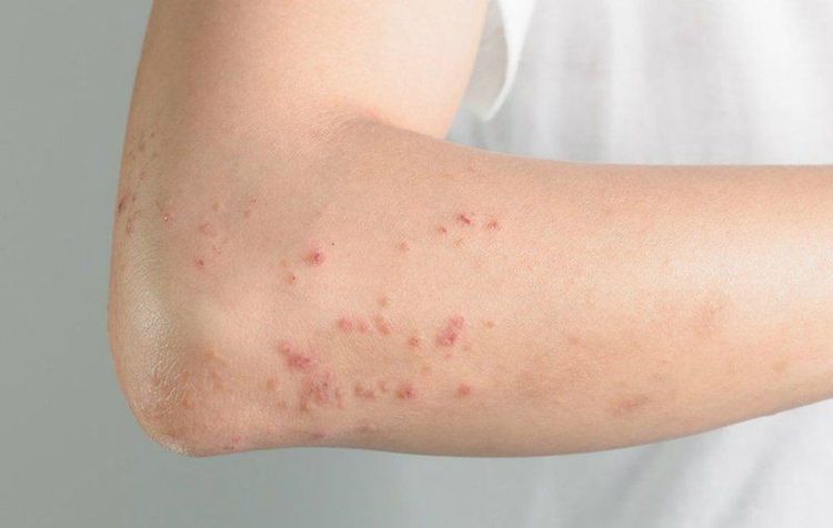 Bệnh sởi là bệnh dẫn đến suy giảm miễn dịch cấp tính
