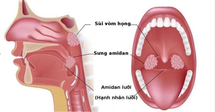 External carotid artery ligation is indicated when the patient has bleeding after tonsillectomy.
