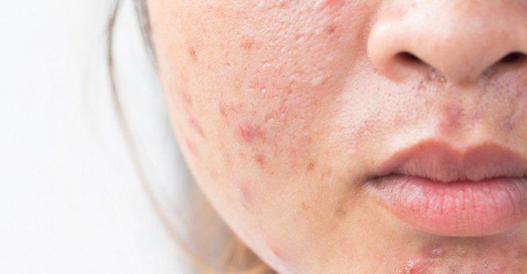 Oily face and acne
