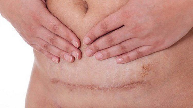 
Có thể vệ sinh vết mổ bằng dung dịch betadin hoặc povidine 10%, giúp vết mổ sẽ nhanh liền sẹo và tránh nhiễm trùng
