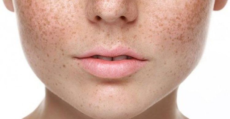 Nám da thường xảy ra ở phụ nữa có thai và sau khi sinh