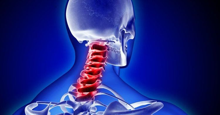 Sau phẫu thuật đốt sống cổ bằng nẹp vít bao lâu có thể tháo bỏ nẹp vít?