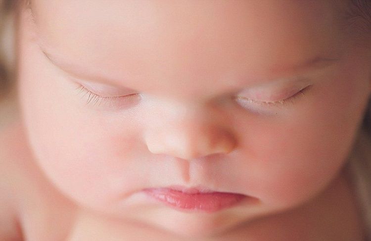 Hội chứng Robinow là một rối loạn di truyền rất hiếm gặp, ảnh hưởng chính đến sự phát triển của hệ xương, cấu trúc khuôn mặt