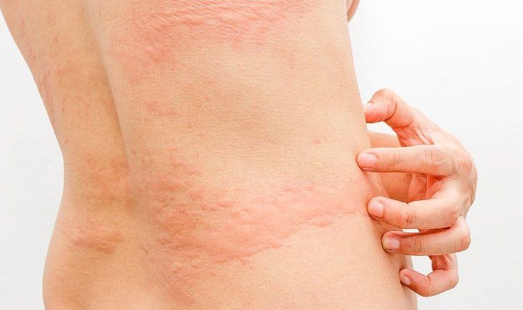 Hives initially present as pink or red raised bumps resembling mosquito bites.  
