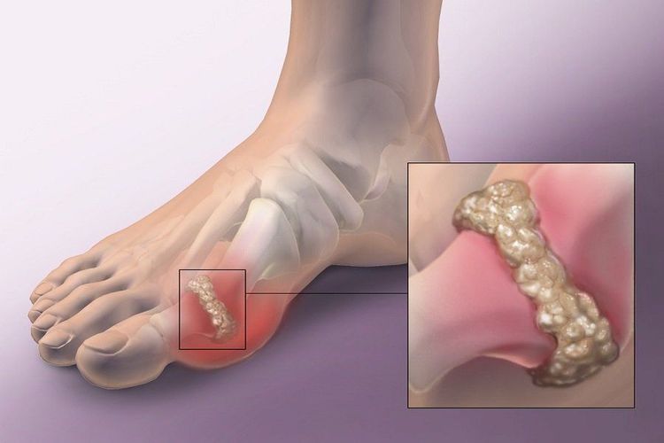 Gout cũng là một trong các vấn đề thường gặp ở khớp gối.
