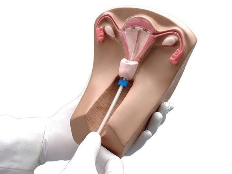 You can use a copper IUD instead of emergency contraception
