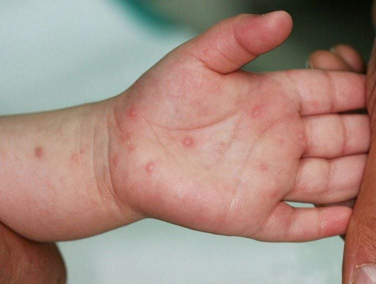Hand, foot, and mouth disease typically presents with a red, non-itchy rash on the palms of the hands, soles of the feet, and buttocks.
