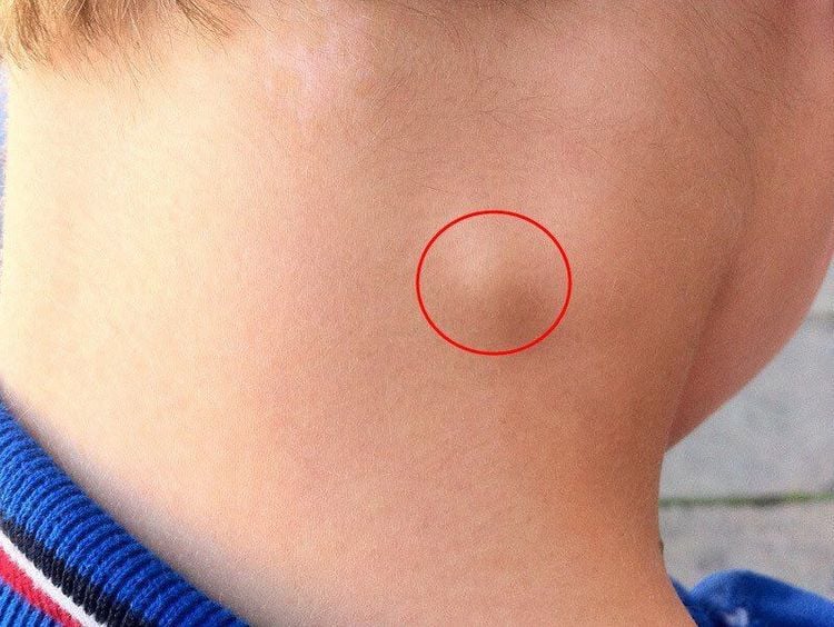 Benign lymph nodes typically resolve within a few days.