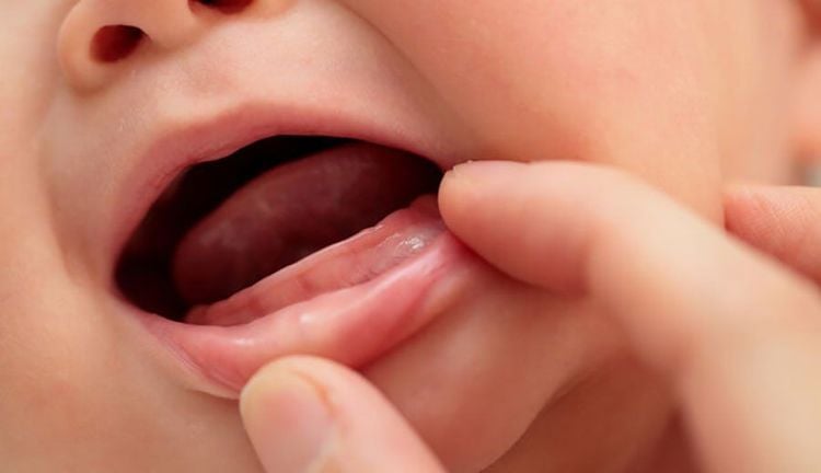 Một trong những nguyên nhân chính khiến trẻ mọc răng chậm là do di truyền