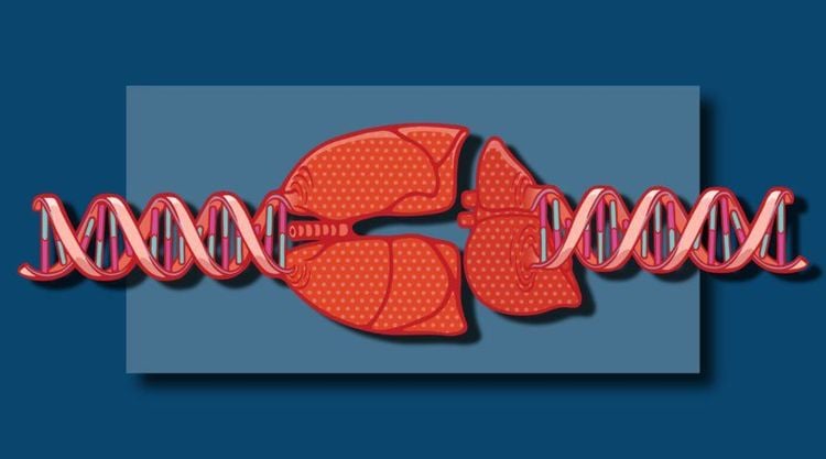 Thiếu hụt alpha 1 antitrypsin mắc phải được tìm thấy ở các bệnh nhân có hội chứng thiếu hụt protein