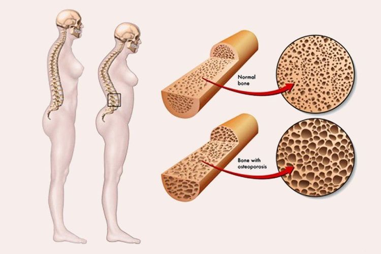 Nhóm Thiazolidinedione có nhược điểm dễ gây loãng xương, gãy xương