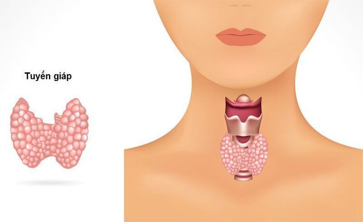 U tuyến giáp tiến triển rất chậm nên khó phát hiện