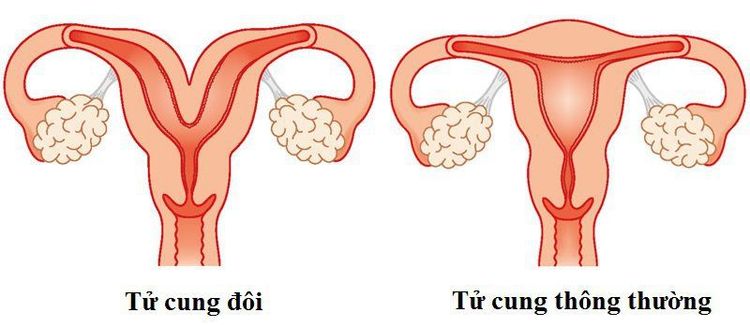 Tử cung đôi là nguyên nhân dẫn đến phụ nữ có khả năng sinh non hoặc gây nguy hiểm cho thai nhi
