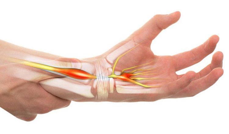 The carpal tunnel syndrome can cause pain, tingling, or swelling in the fingers