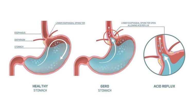 GERD can cause heartburn symptoms for patients 
