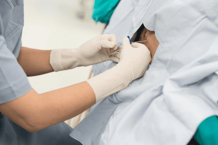 Spinal Anesthesia Illustration