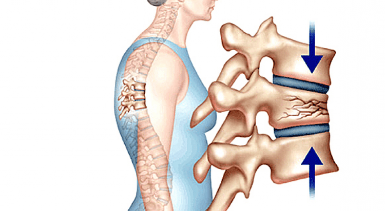 Hình ảnh gãy lún xương cột sống