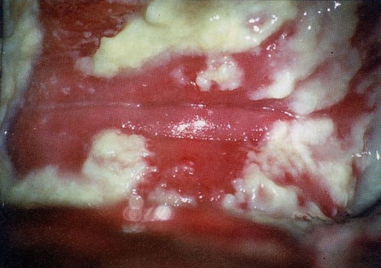 Image of Candidiasis inside the vagina.