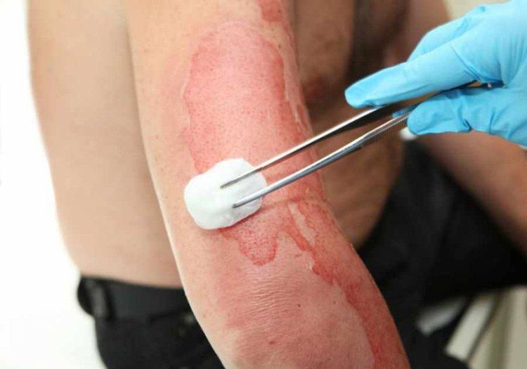 Vết bỏng cần được theo dõi hàng ngày để phòng ngừa nhiễm trùng