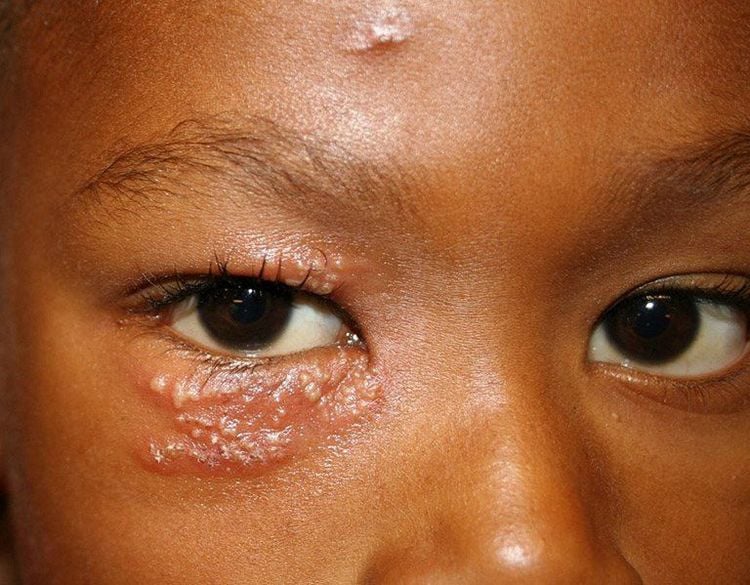 Zona thần kinh có thể dẫn đến nhiều biến chứng