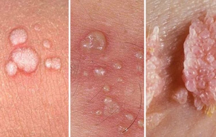 Cấy que tránh thai không phòng được các bệnh lây nhiễm qua đường tình dục
