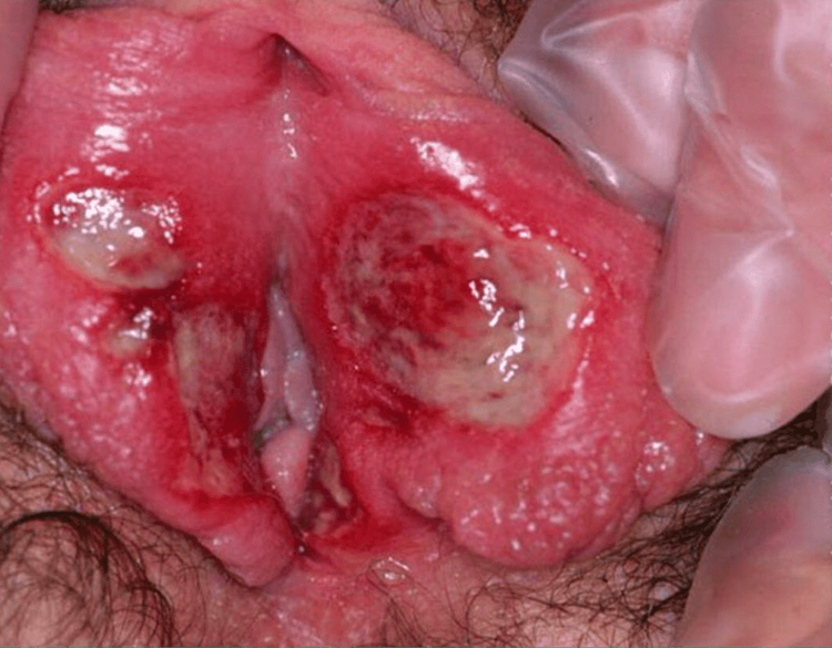 Illustration of an acute vaginal ulcer.
