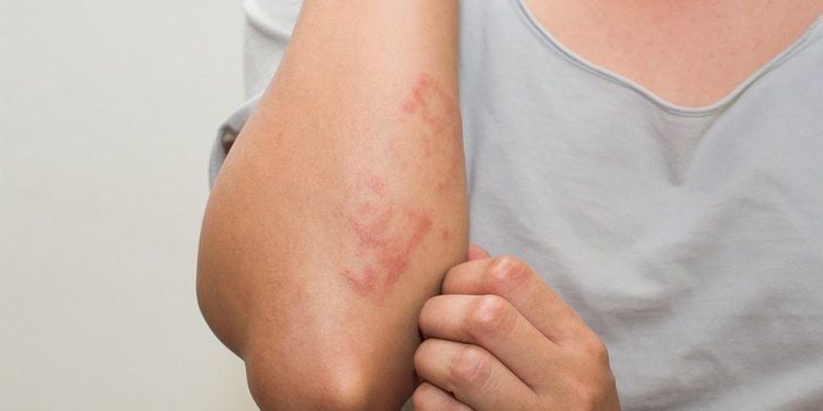 Ratching the shingles rash should be avoided, as it can increase the risk of secondary infection and may leave scars.