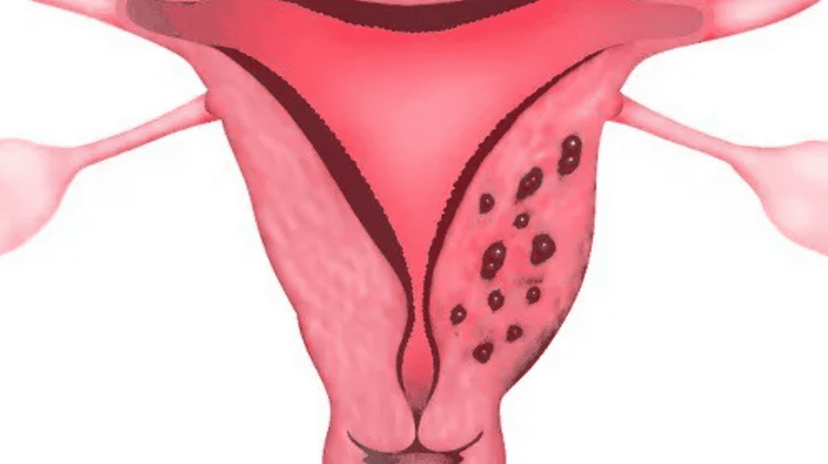 Endometriosis is a more severe condition affecting women during their menstrual cycle  