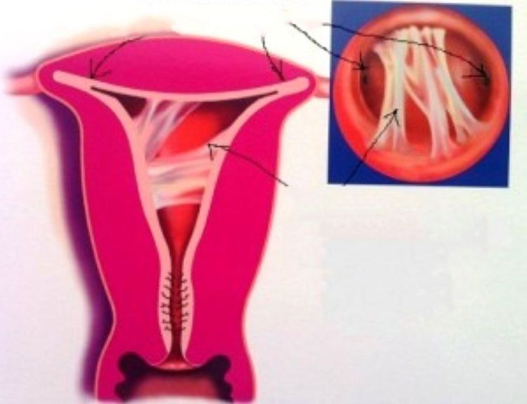 Be Aware of Uterine Adhesions After Abortion