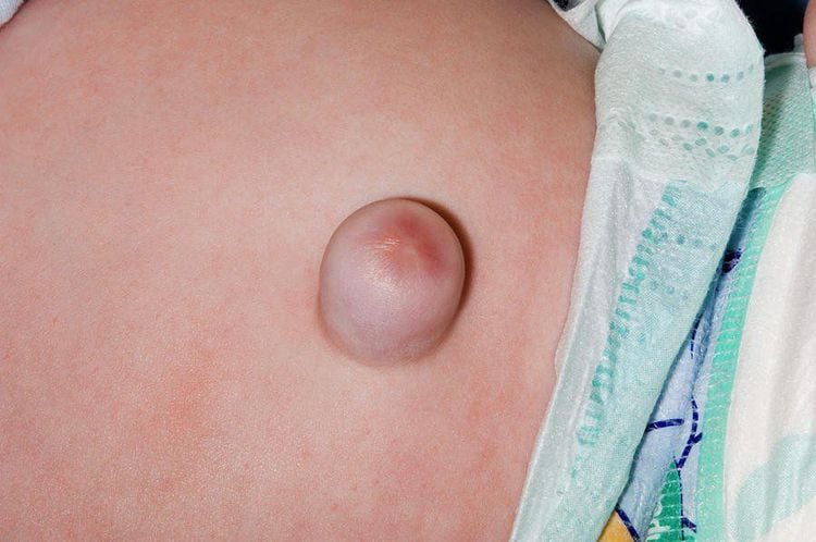 The hernia is visible